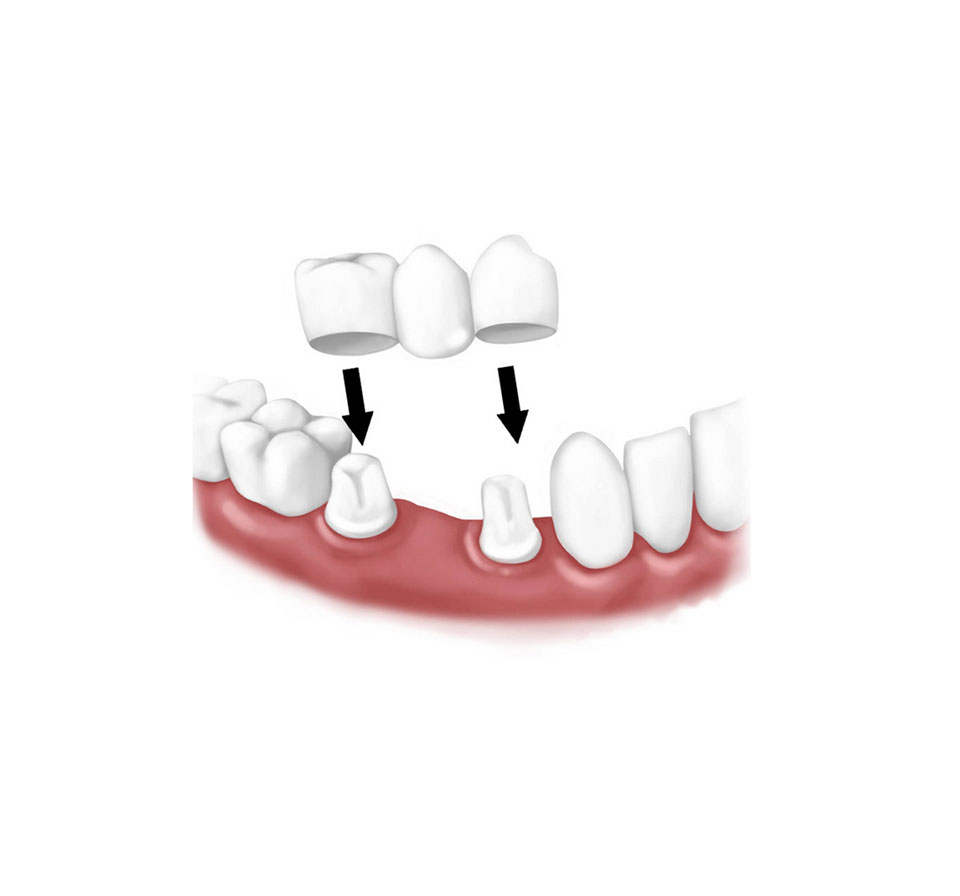 Dental Bridge