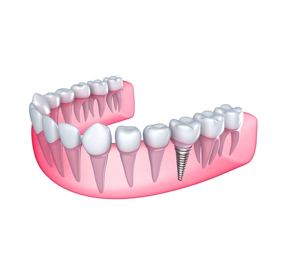 Dental Implants