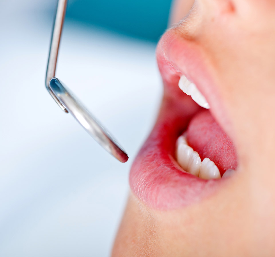 Composite Fillings