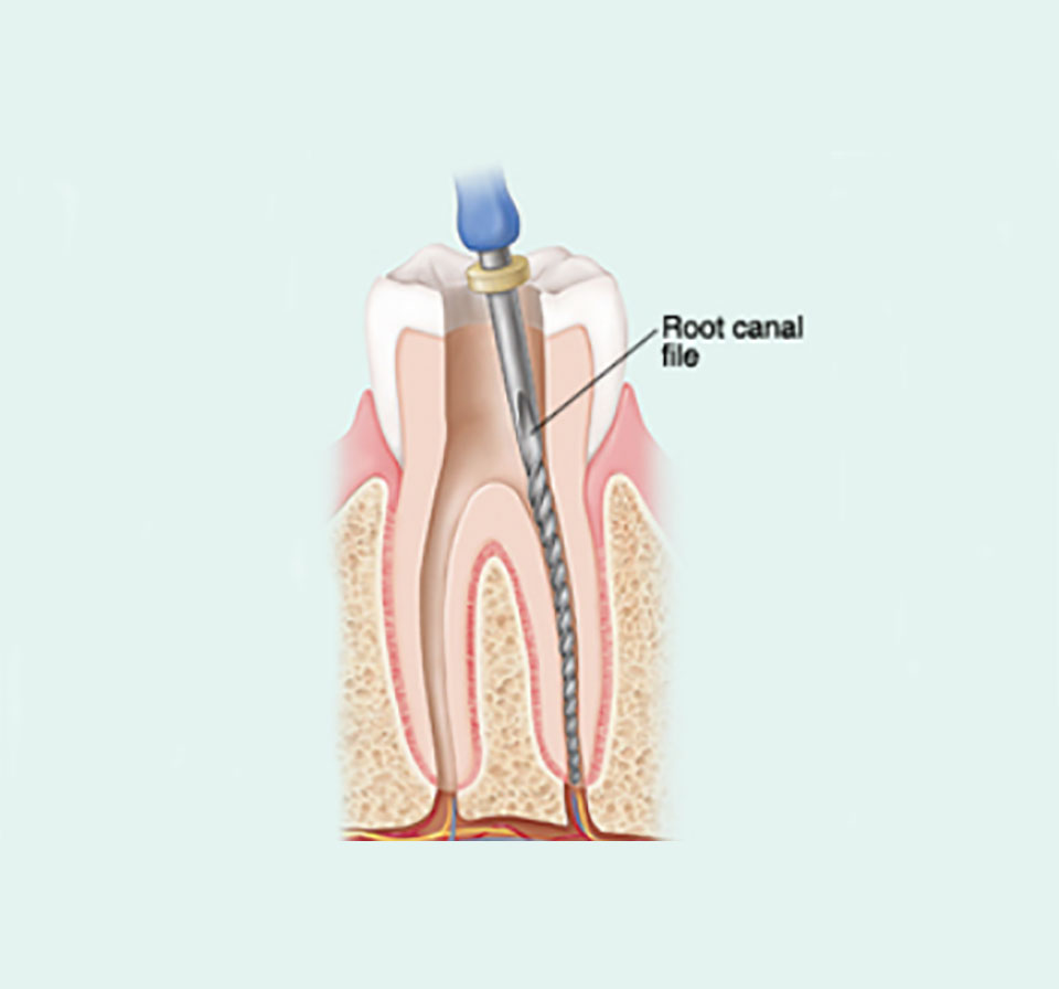 Root Canal